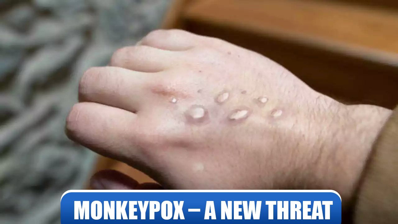 Monkey Pox – a new threat